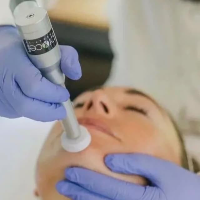 3 Procell Microchanneling Sessions at Candice Marie Esthetics in Yardley, PA